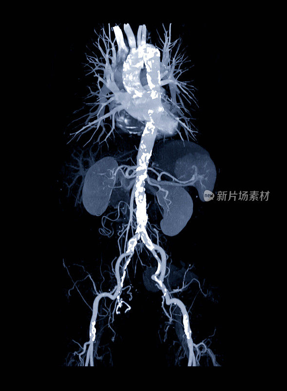 CTA腹主动脉三维图像名称为最大强度投影(Maximum intensity projection, MIP)显示心脏和血管。